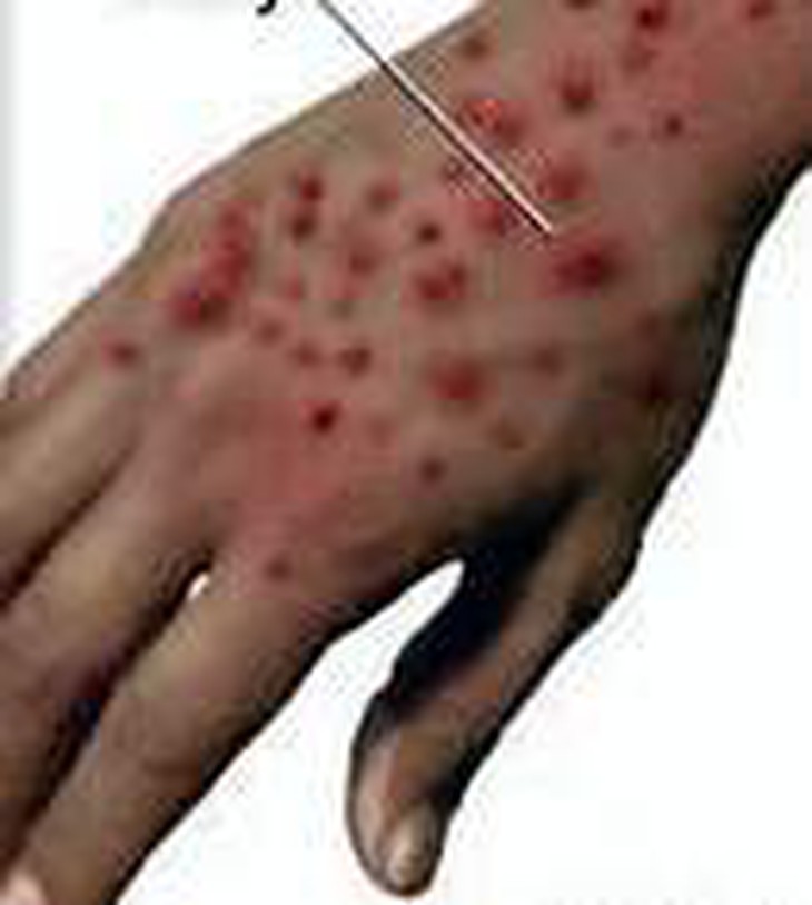 Bệnh sốt xuất huyết do virut Ebola, Marburg và cách phòng, chống